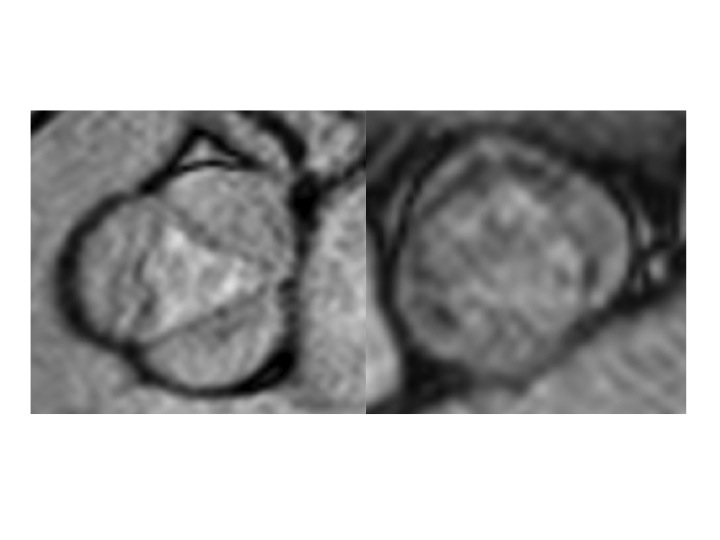 Más de un millón de españoles debería tomar un antibiótico antes de ir al dentista para prevenir una infección del corazón