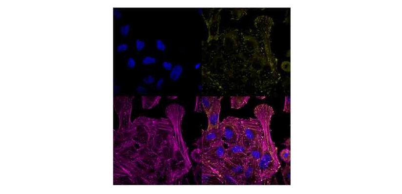 Identifican una patología genética ósea rara a partir de métodos de secuenciación masiva