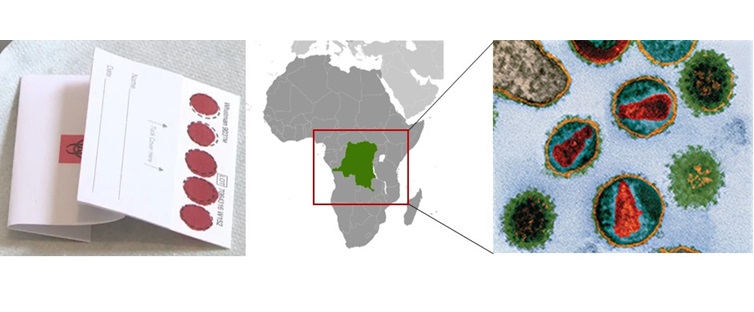 El alto nivel de resistencia a los ARV podría limitar el control del VIH en población pediátrica y adolescente en Kinshasa