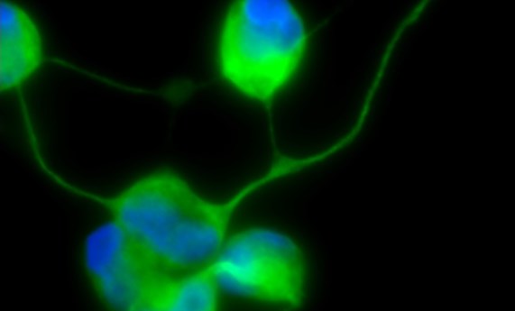 Generan neuronas mediante reprogramación directa de las células de la piel de pacientes mitocondriales con el síndrome MELAS Generan neuronas mediante reprogramación directa de las células de la piel de pacientes mitocondriales con el síndrome MELAS