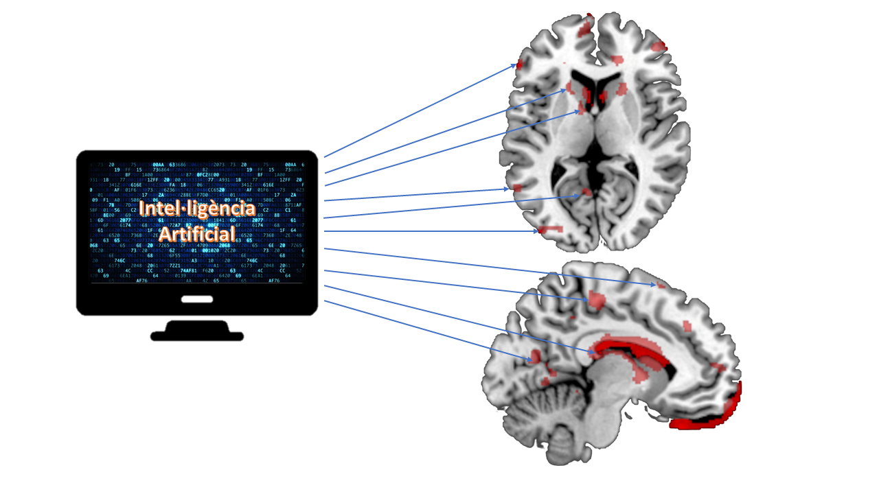 La resonancia magnética podría predecir el riesgo de recaída después de un primer brote psicótico