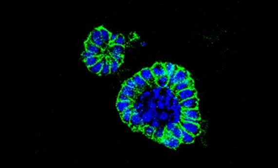 Un nuevo fármaco frente a un transportador de aminoácidos es efectivo en cáncer de colon Un nuevo fármaco frente a un transportador de aminoácidos es efectivo en cáncer de colon
