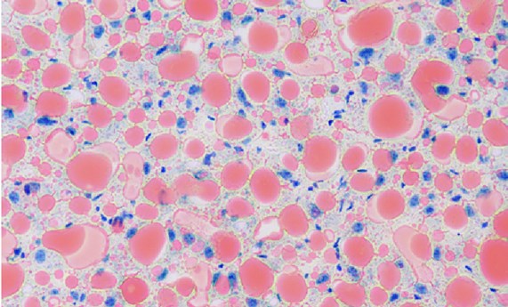 Descubren una proteína protectora contra el hígado graso, la enfermedad hepática más común en los países occidentales Descubren una proteína protectora contra el hígado graso, la enfermedad hepática más común en los países occidentales